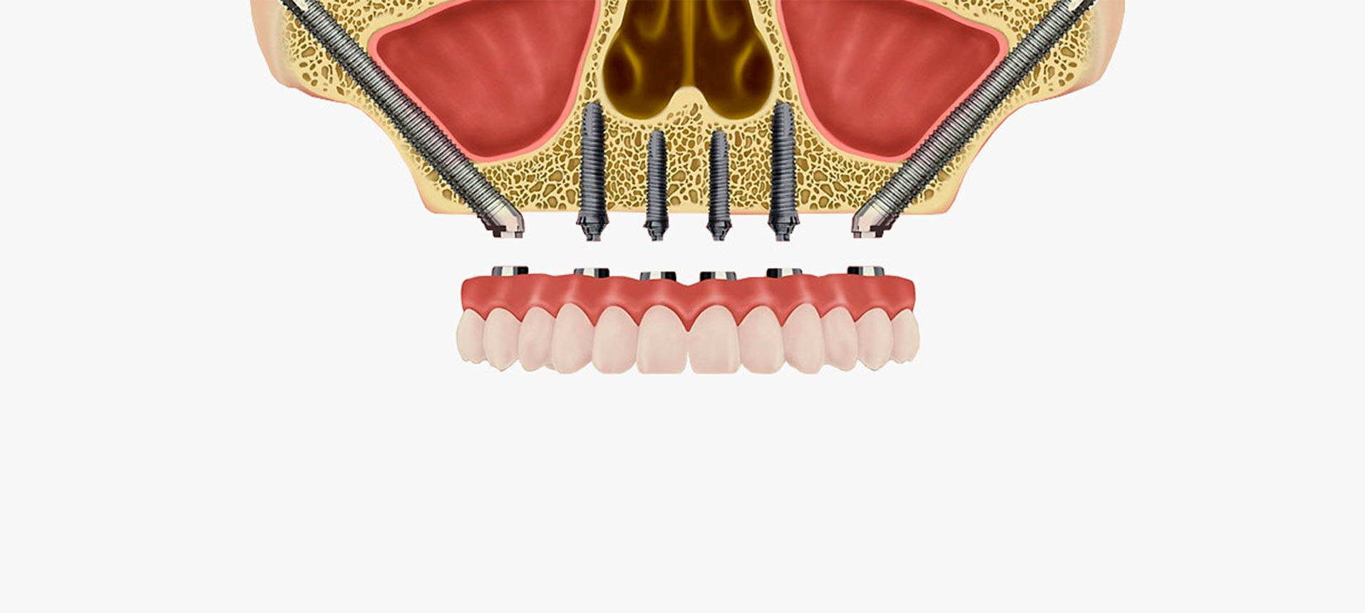 Implantes cigomáticos en Fuenlabrada